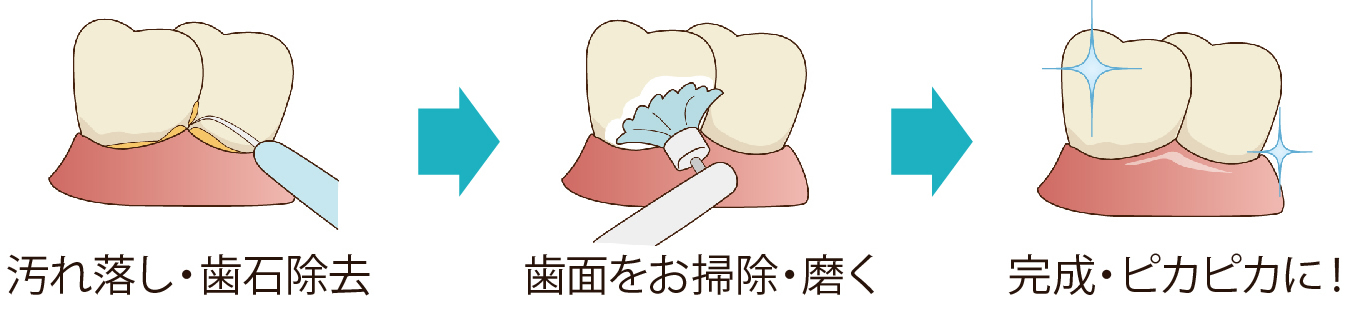 歯のクリーニング・PMTC