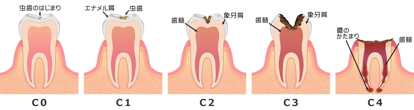 虫歯の原因と進行について